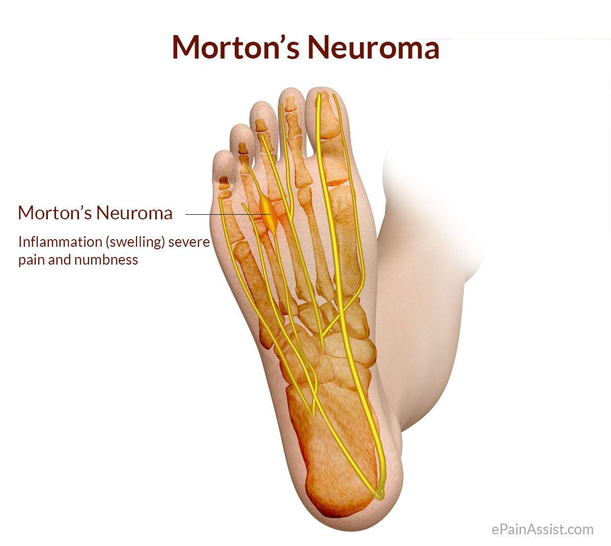 medial plantar nerve entrapment foot problems manual
